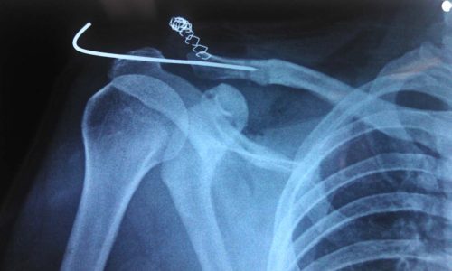 ¿QUÉ PASA CUANDO OCURRE UNA LUXACIÓN ACROMIO – CLAVICULAR?